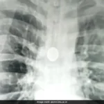 Coin Stuck In Man's Windpipe