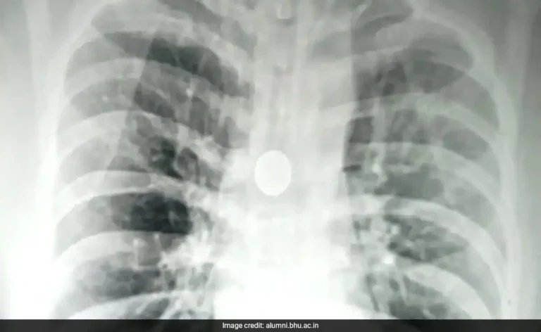 Coin Stuck In Man's Windpipe